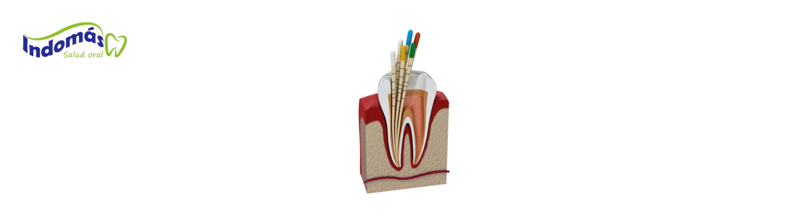 Endodoncia Indomas